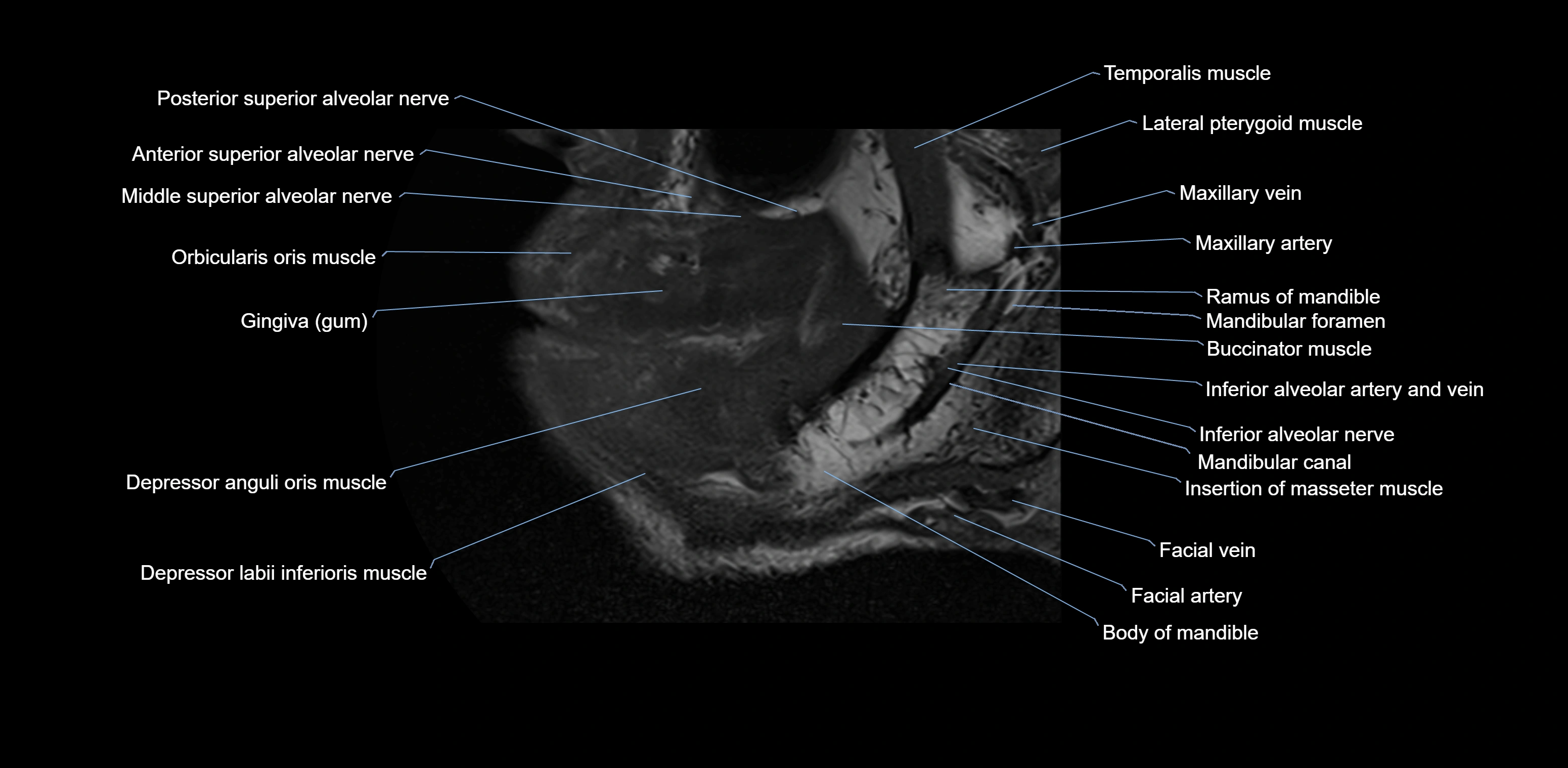 Dental MRI( tooth) sagittal labelled  cross sectional 3T anatomy -img-00001-00003.webp